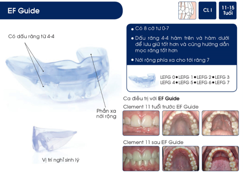 Hàm định hình khớp răng EF Line Orthoplus