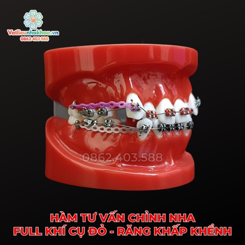 Hàm tư vấn chỉnh nha full khí cụ đỏ - Răng khấp khểnh