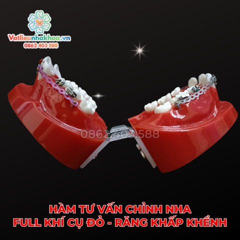 Hàm tư vấn chỉnh nha full khí cụ đỏ - Răng khấp khểnh