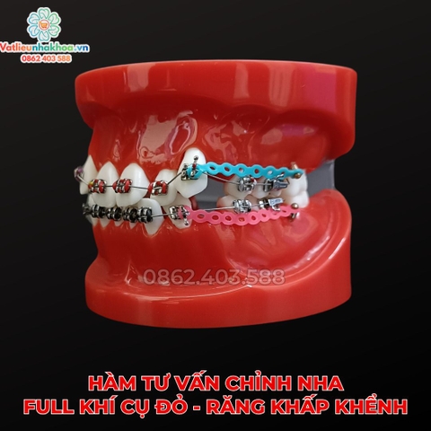 Hàm tư vấn chỉnh nha full khí cụ đỏ - Răng khấp khểnh
