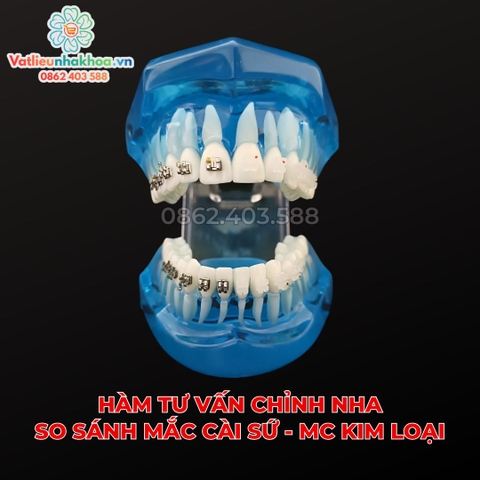 Hàm tư vấn so sánh chỉnh nha mắc cài sứ và kim loại