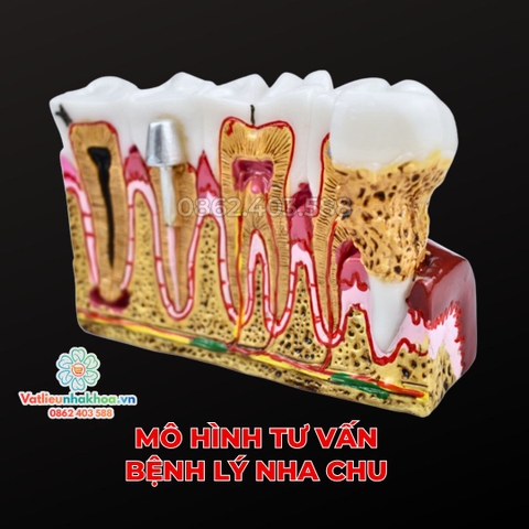 Mô hình tư vấn bệnh lý nha chu