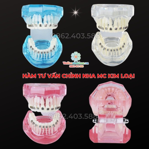 Hàm tư vấn chỉnh nha mắc cài kim loại