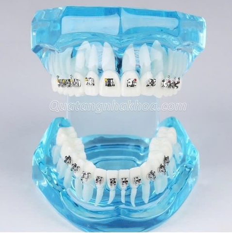 Hàm tư vấn chỉnh nha mắc cài kim loại