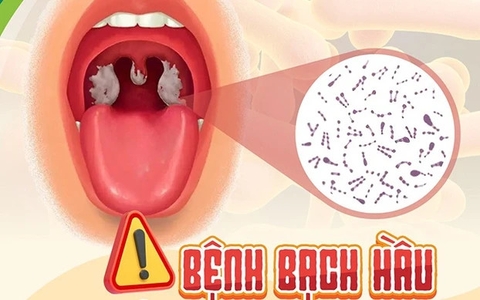 ​Bệnh bạch hầu