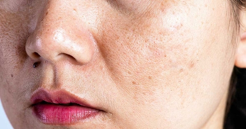 Da Không Đều Màu - Thiết Lập Quy Trình Skincare Lấy Lại Làn Da Rạng Rỡ