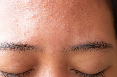 Da Mặt Bị Sần Sùi: Nguyên Nhân Và Lộ Trình Phục Hồi