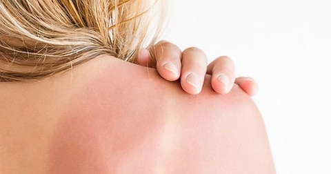Da Cháy Nắng Khi Đi Biển - Làm Sao Để Khắc Phục?