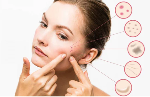 Cách Trị Thâm Mụn Nhanh Tại Nhà