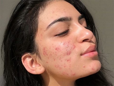 Những Sai Lầm Khiến Mụn Ngày Càng Nặng Hơn