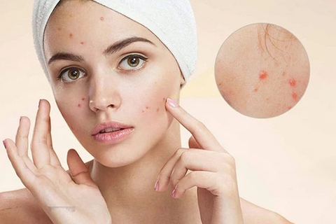Phân biệt các loại mụn thường gặp và cách xử lý