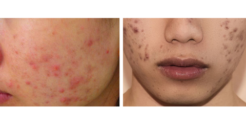 Tạm Biệt Thâm Mụn: Phân Biệt Thâm Đỏ (PIE) & Thâm Đen (PIH)