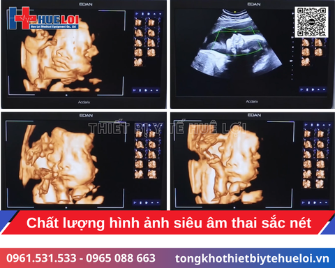 Hệ thống siêu âm bàn đẩy cao cấp Edan Acclarix LX85