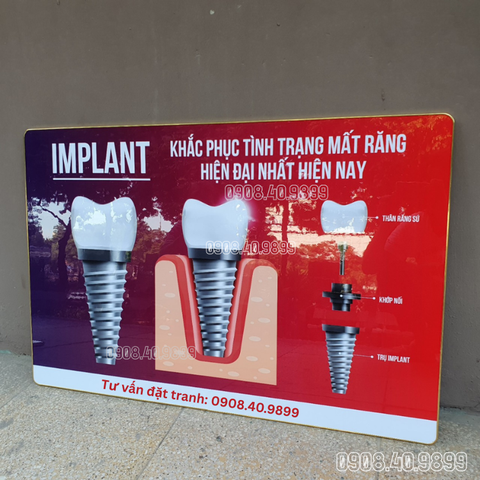 Tranh Implant nha khoa công nghệ cao - MS11