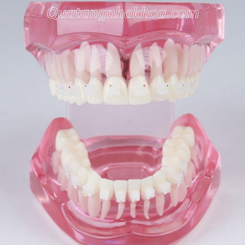 Hàm tư vấn chỉnh nha mắc cài sứ