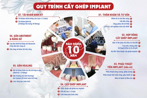 Tranh Quy trình cấy ghép implant Nha khoa