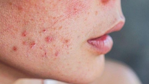 Để không bùng mụn khi mới dùng tretinoin/ retinoid - Cần làm gì?