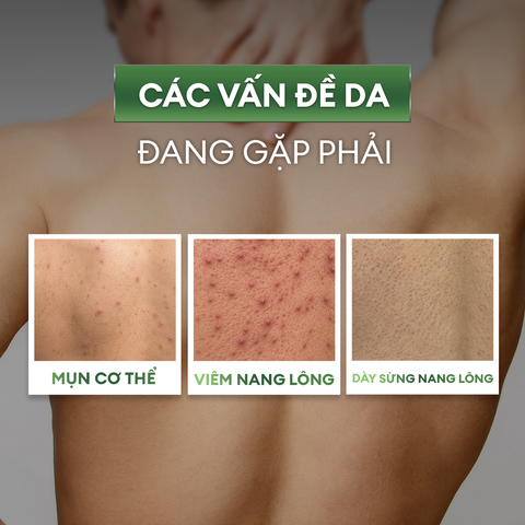 Xịt giảm mụn và mờ thâm cơ thể Exfoliating Body Spray 100ml