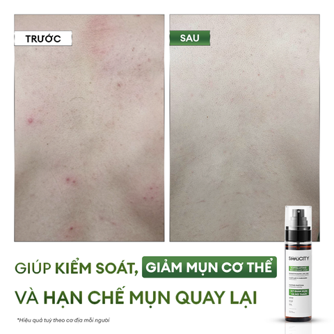 Xịt giảm mụn và mờ thâm cơ thể Exfoliating Body Spray 100ml
