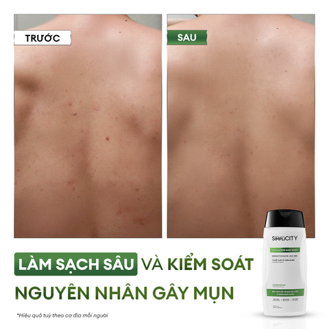 Sữa tắm tẩy tế bào chết & giảm mụn lưng Exfoliating Body Wash 250ml