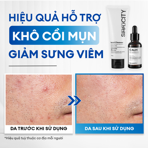 Combo Acne Duo giảm mụn sưng viêm: Sữa rửa mặt 100g và Serum Calm 30ml