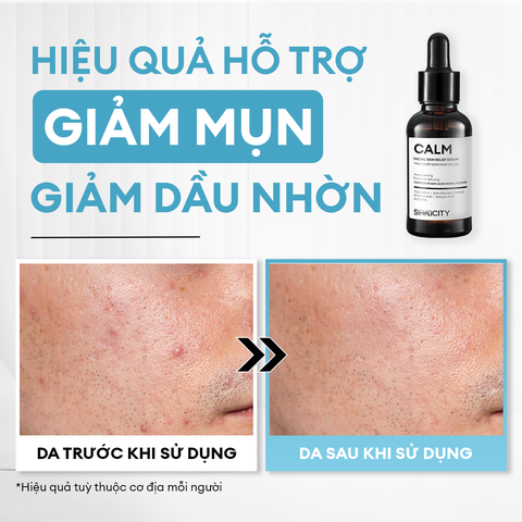 Serum Calm giảm mụn kiềm dầu BHA + Phức hợp thảo mộc 30ml