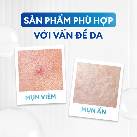 Combo Acne Duo giảm mụn sưng viêm: Sữa rửa mặt 100g và Serum Calm 30ml