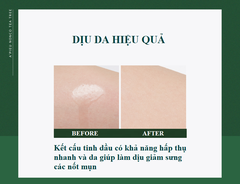 Tinh Dầu Tràm Trà Chăm Sóc Da Mụn, Làm Dịu Da Apieu Nonco Tea Tree Oil