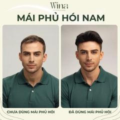 Tự Ti Vì Bị Rụng Tóc Nhiều – Làm Sao Để Khắc Phục Và Tự Tin Trở Lại
