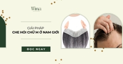 Giải Pháp Che Hói Chữ M Ở Nam Giới Tự Nhiên Nhất Hiện Nay