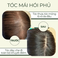 Tình Trạng Nào Thì Sử Dụng Tóc Giả Che Hói Đỉnh Đầu Nữ?