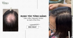 Rụng Tóc Từng Mảng: Dấu Hiệu, Nguyên Nhân & Cách Che Phủ