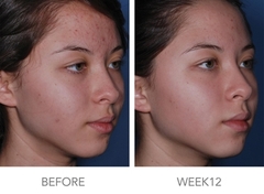 Lotion tẩy da chết, sạch sâu, trị mụn Obagi Clenziderm MD Pore Therapy 148ml- Mỹ