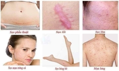 Kem trị sẹo Gentacin 10g - Nhật bản