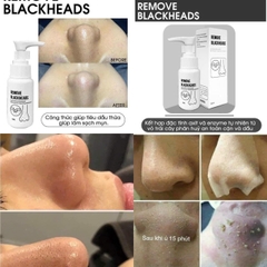 Ủ mụn đầu đen Remove Blackheads làm sạch sợi bã nhờn 50ml - Mỹ