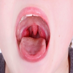 Dấu hiệu nhận biết sớm và điều trị kịp thời ung thư vòm họng