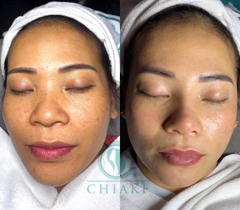 CHIAKI ĐẶC TRỊ NÁM SPA NHẬT