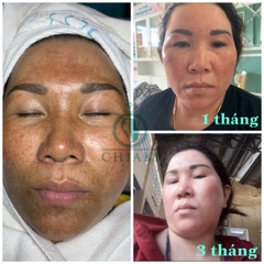 CHIAKI ĐẶC TRỊ NÁM SPA NHẬT