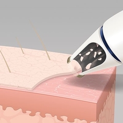 Máy siêu mài mòn kim cương cầm tay HoMedics công nghệ Microdermabrasion, trẻ hóa da HoMedics MDA-100