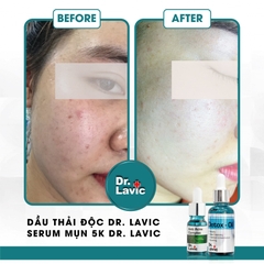 Dầu thải độc tố, giảm tiết bã nhờn, giảm sưng viêm Se Khít Lỗ Chân Lông Công Nghệ USA DR.LAVIC Detox - Oil 30ML - DR913M