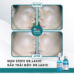 Dầu thải độc tố, giảm tiết bã nhờn, giảm sưng viêm Se Khít Lỗ Chân Lông Công Nghệ USA DR.LAVIC Detox - Oil 30ML - DR913M