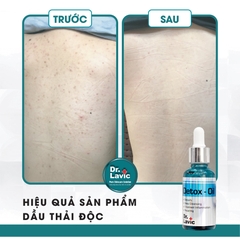 Dầu thải độc tố, giảm tiết bã nhờn, giảm sưng viêm Se Khít Lỗ Chân Lông Công Nghệ USA DR.LAVIC Detox - Oil 30ML - DR913M