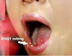 Gel bôi đặc trị nhiệt miệng, loét miệng,Nhiệt lợi, lưỡi SOS Mund - Heilgel