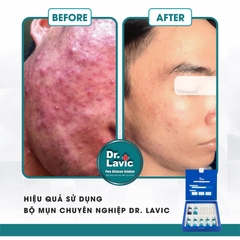 Bộ mụn chuyên nghiệp Professional Treatment Acne - DR.LAVIC DR905