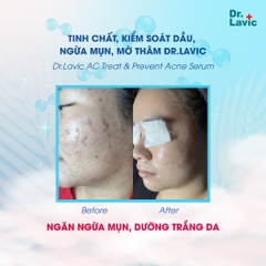 Serum ngừa mụn Dr.Lavic AC Treat & Prevent Acne kiềm dầu, chống tái phát mụn mờ thâm 10ml DR958