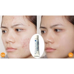 Kem Trị Mụn Dalacin T Gel 1% 10g