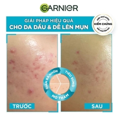 Tinh chất Giảm Mụn Mờ Thâm Cho Da Dầu Mụn Garnier Skin Naturals Bright Complete Anti - Acne Booster Serum 30ml