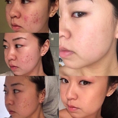 Kem Làm Giảm Mụn Galderma Differin 0.1% Differin Adapalene Gel 0.1% Acne Treatment 30g