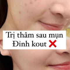 Kem dưỡng Fixderma Skarfix – TX Cream 15g (ktđ)