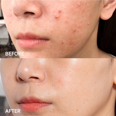 Kem Dưỡng Đặc Trị Mụn 